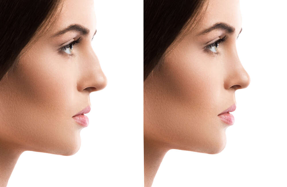 Brunette patient, nose job before and after. Medazur Medical Clinic in Leytonstone.