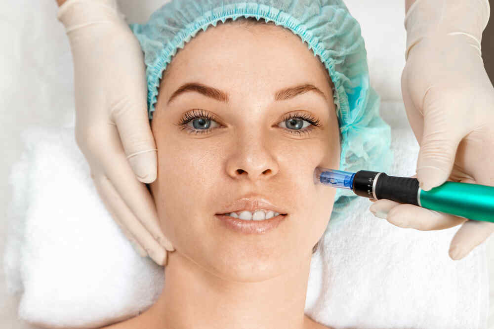 Microneedling performed on young lady. Medazur Medical Clinic in Leytonstone.