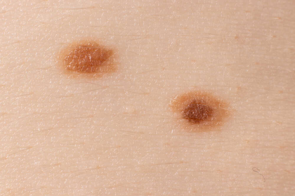 Skin with two moles on it. Medazur Medical Clinic in Leytonstone.